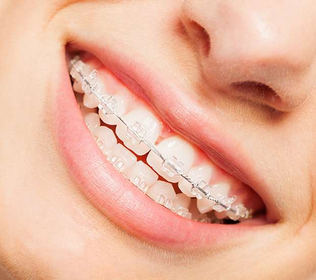 Rancho Cucamonga Clear Braces