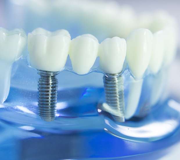 Rancho Cucamonga Dental Implants